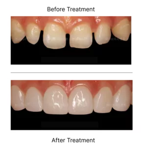 Teeth space treatment