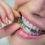 Invisalign Before and After: What You Need to&hellip;