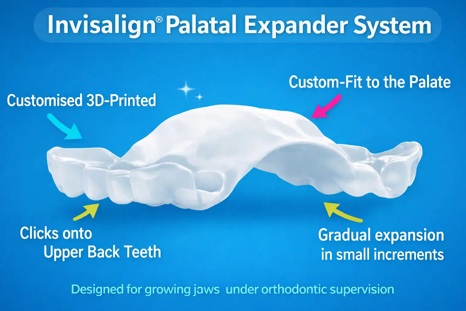 removable palatal expander